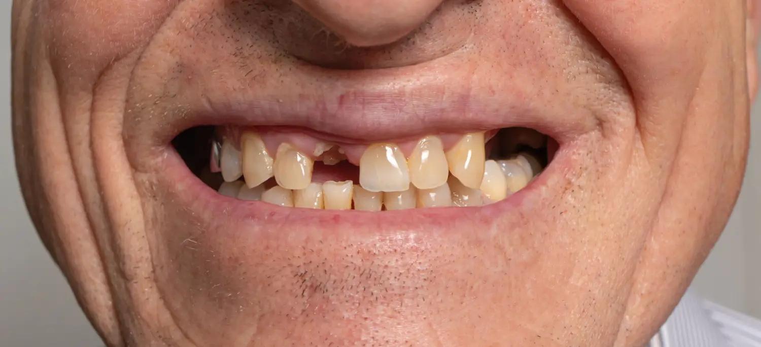 Những trường hợp không nên bọc răng sứ - Chỉ còn lại chân răng (Nguồn: St)